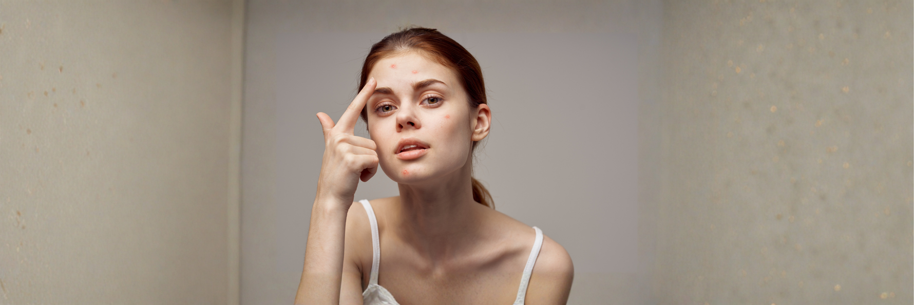 How to Treat Acne Naturally &amp; Effectively