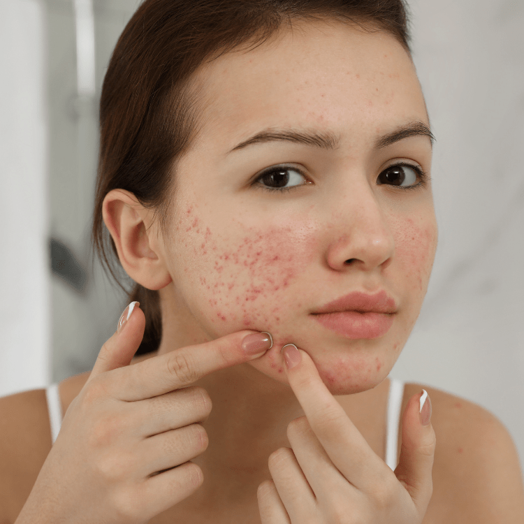 Acne: Causes, Treatments, and Prevention - Cosmosentials