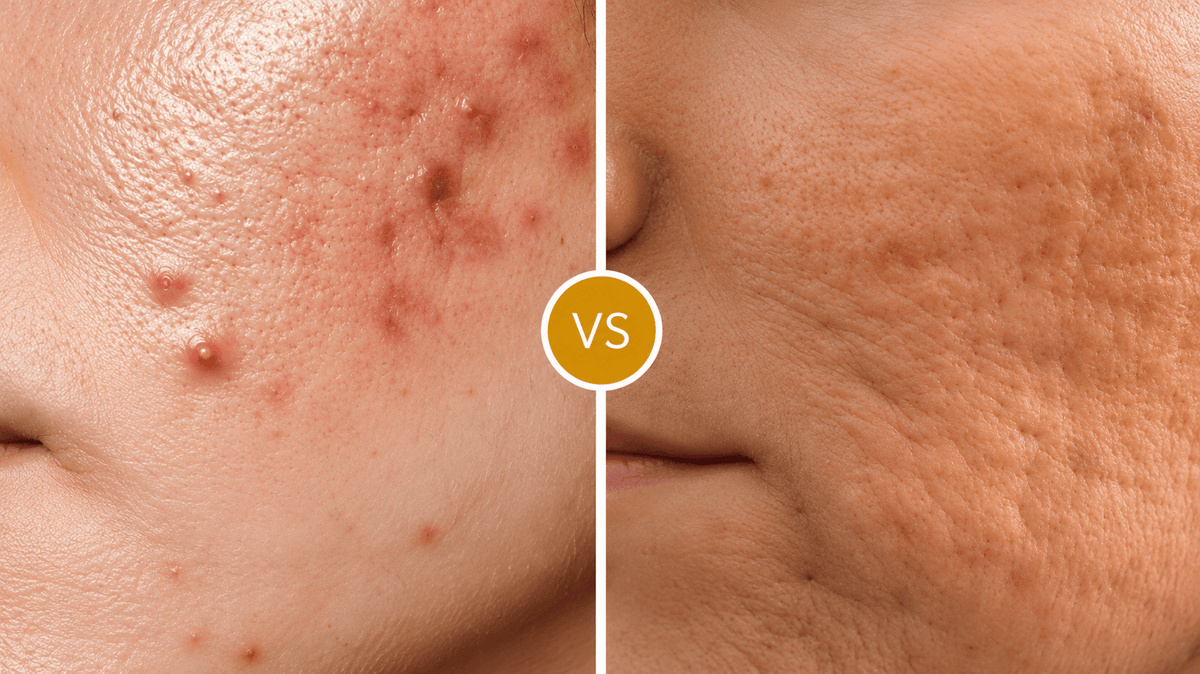 Acne Scars and Marks: What Creams Can Fix and What Cannot Be Fixed at Home - Cosmosentials