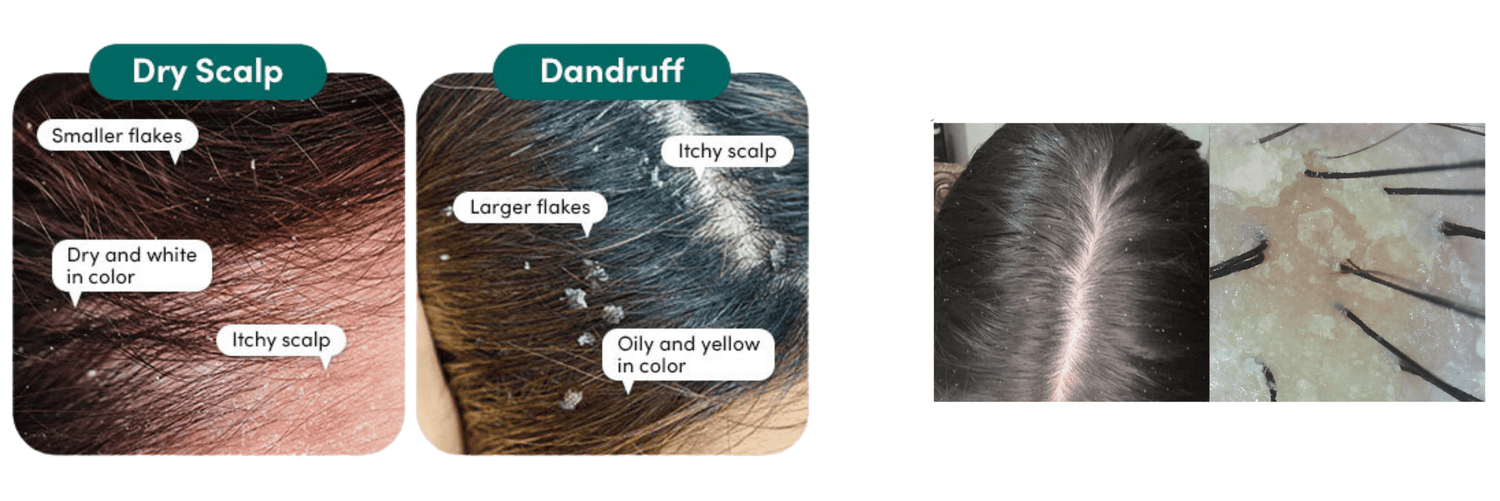 Dandruff Causes &Treatments - Cosmosentials