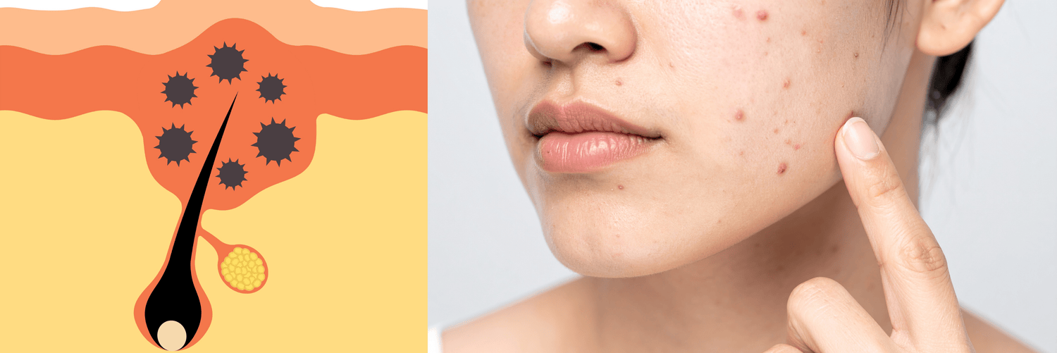 How to Treat Acne Naturally & Effectively - Cosmosentials