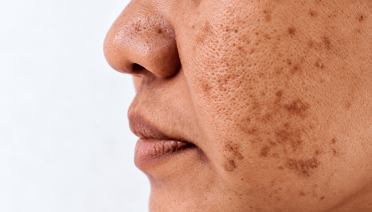 Pigmentation on Indian Skin: Why It Happens and What Actually Helps - Cosmosentials