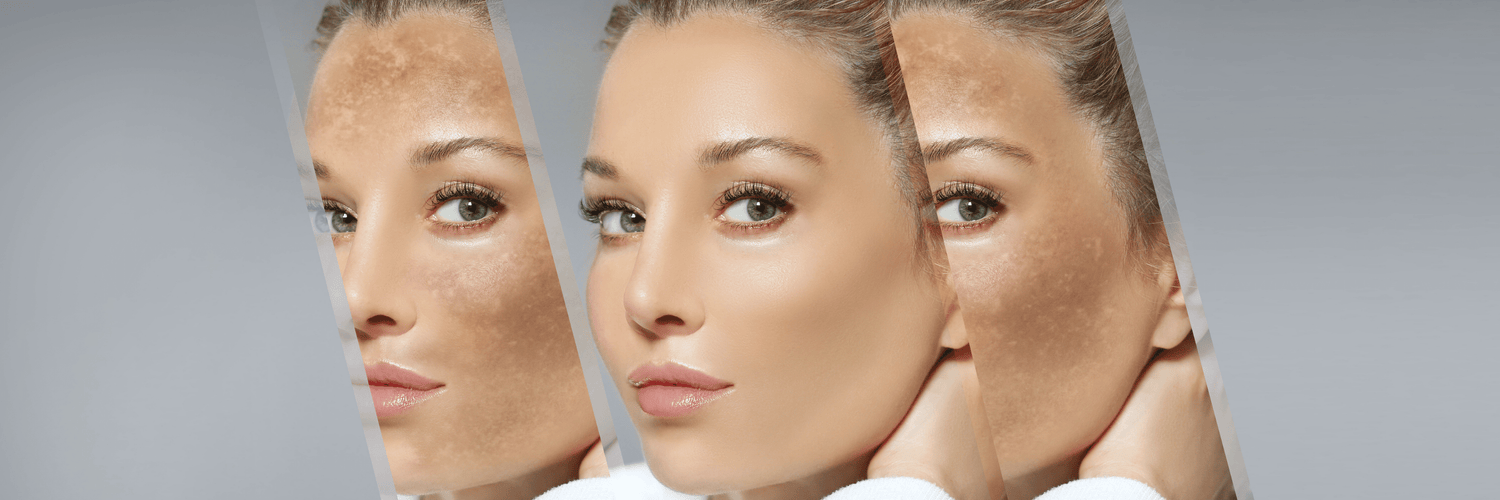 Skincare tips to treat pigmentation and scarring - Cosmosentials