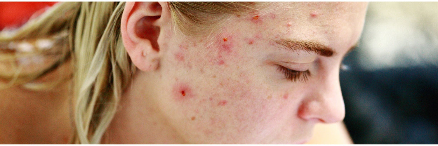 Why It Happens and How to Control It Naturally - Cosmosentials