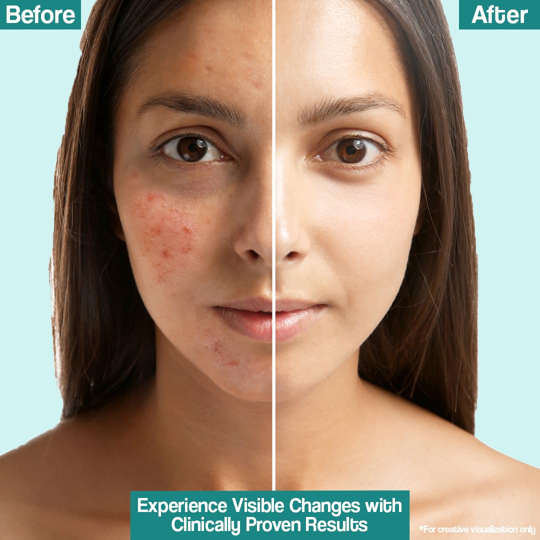 Venusia Acne Control Moisturizer - Cosmosentials